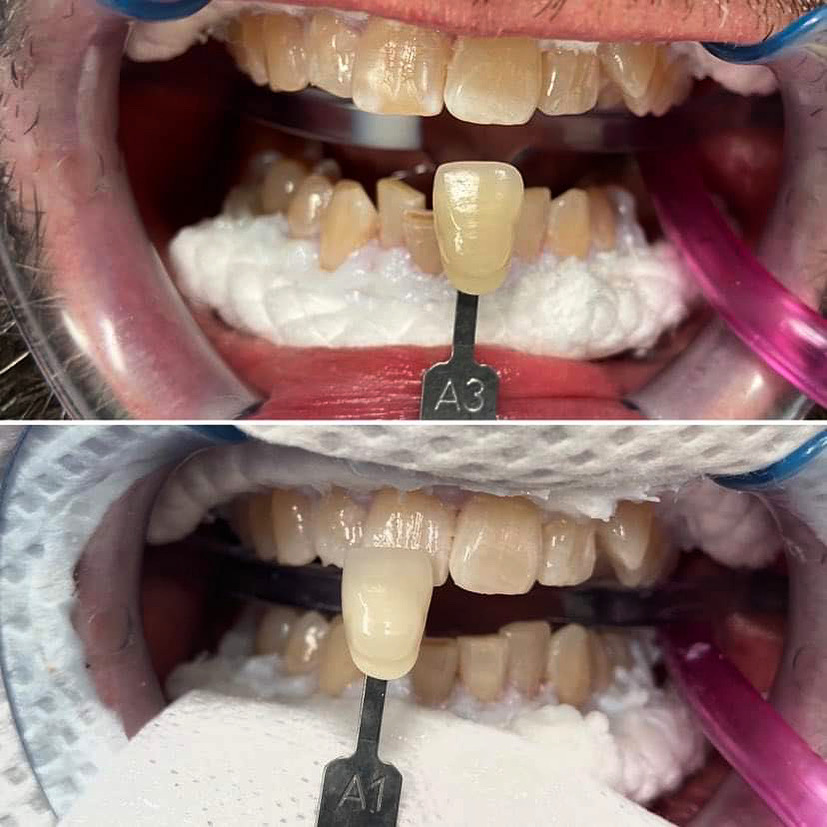 Zęby przed i po wybieleniu