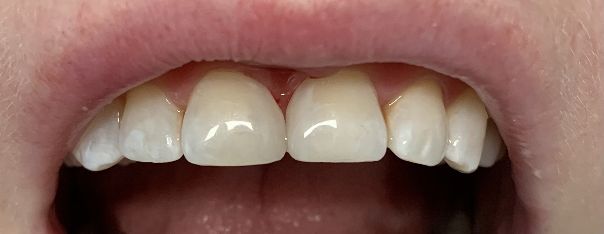 Zęby po wykonanym zabiegu