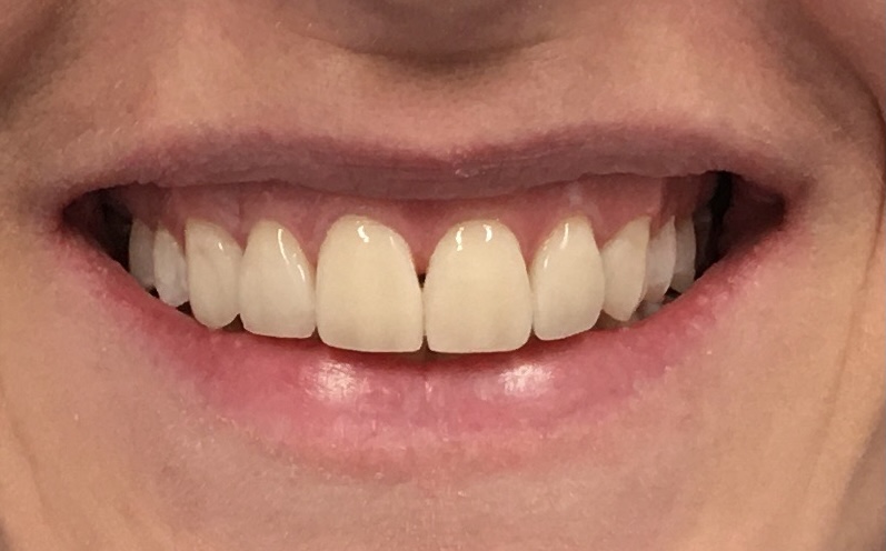 Białe zęby po wizycie u denstysty
