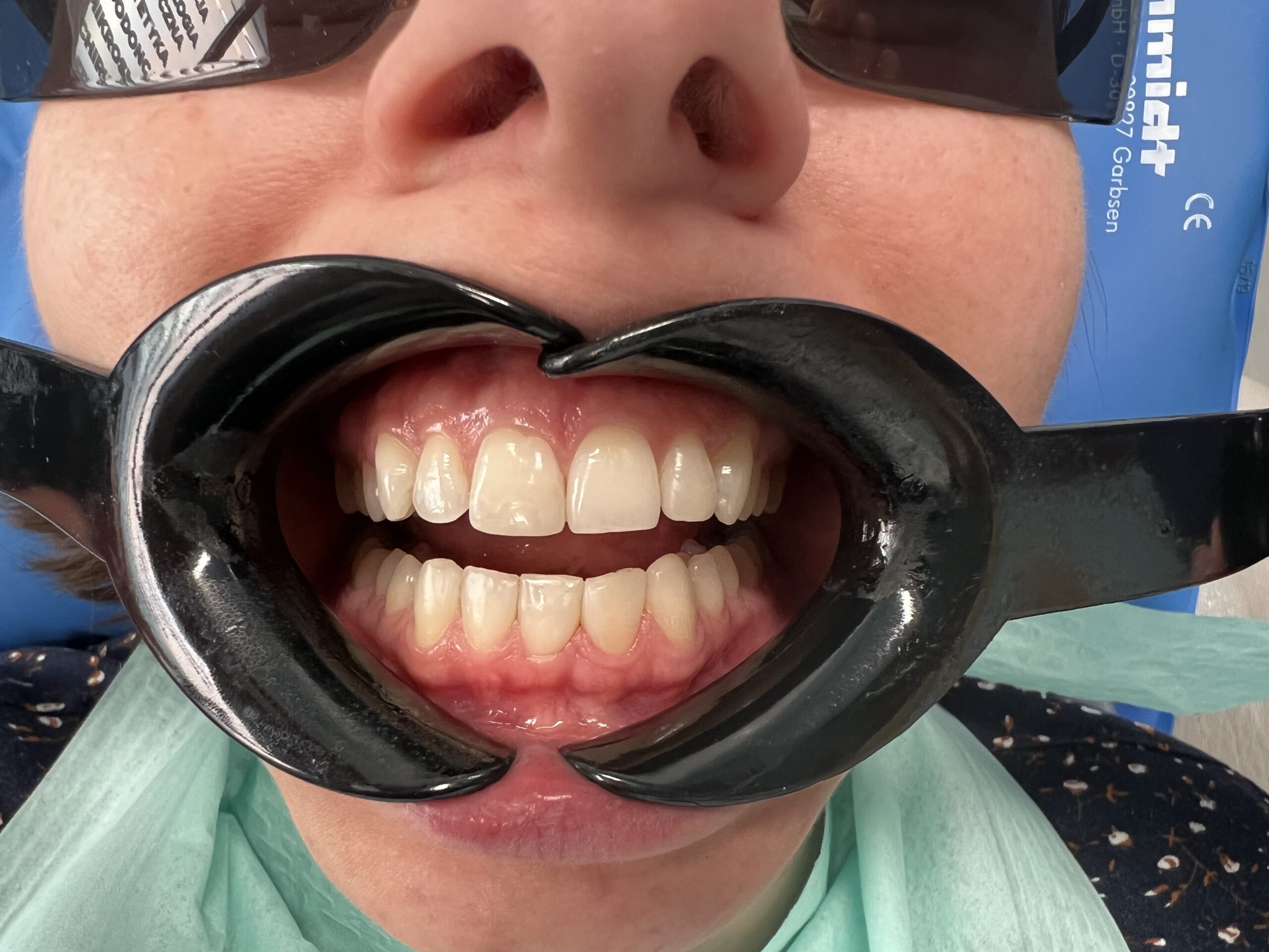 Zęby po wykonanym zabiegu w klinice dentystycznej