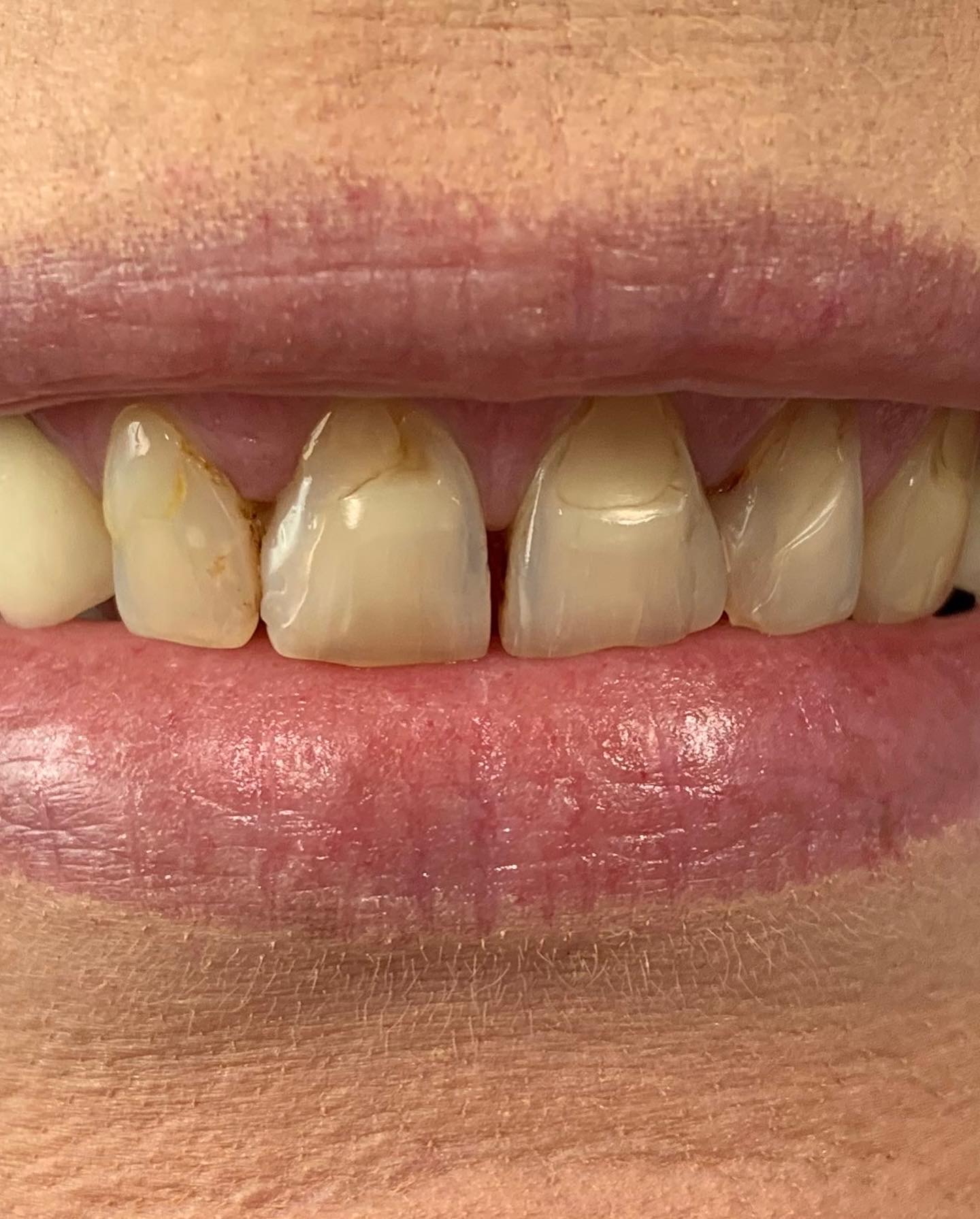 Zęby przed wykonaniem zabiegu