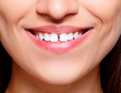 Czym jest diastema i jakie są metody zamknięcia przestrzeni między zębami?