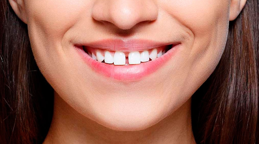 Leczenie przestrzeni między zębami, uzupełnienie diastemy za pomocą bondingu.