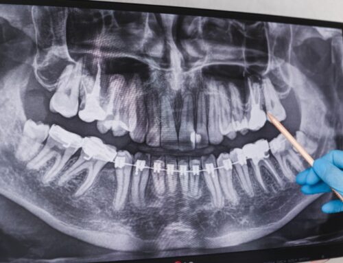 Usuwanie ósemek — co należy wiedzieć o chirurgicznej ekstrakcji zębów mądrości?